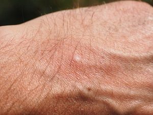 Mosquito Pest Control - Croach - Mosquito bit welt on man's hand