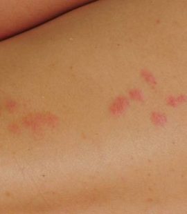 Bedbug Bites Images-bites on the human body-Boise ID-Croach Pest Control-800x400