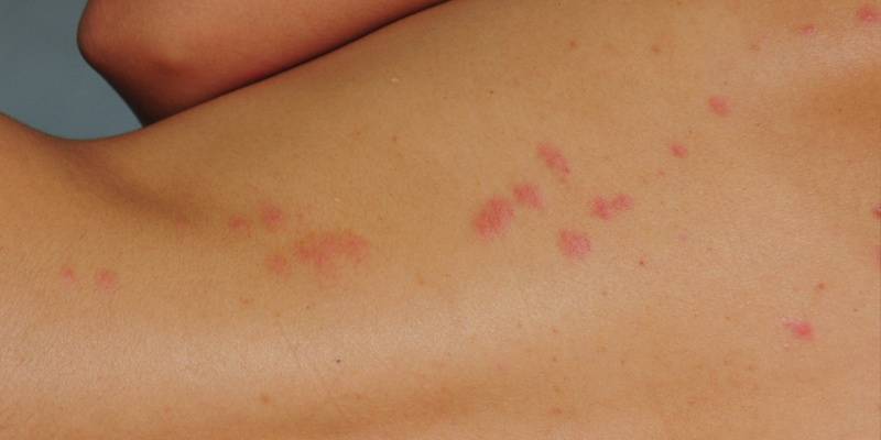 Bedbug Bites Images-bites on the human body-Boise ID-Croach Pest Control-800x400