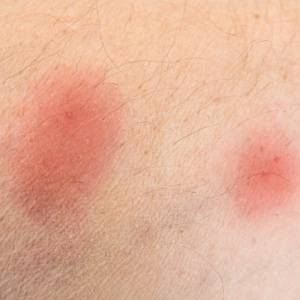 Did the bed bug bite you-FAQs-Croach Pest Control-300x300