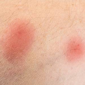 Bed Bug Bites What Do They Look Like Croach Pest Control   Did The Bed Bug Bite You FAQs Croach Pest Control 300x300 1 