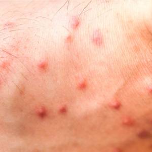 Differences between flea and bedbug bites-Croach Pest Control-300x300