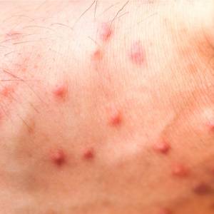 bed bug bites pictures on black people